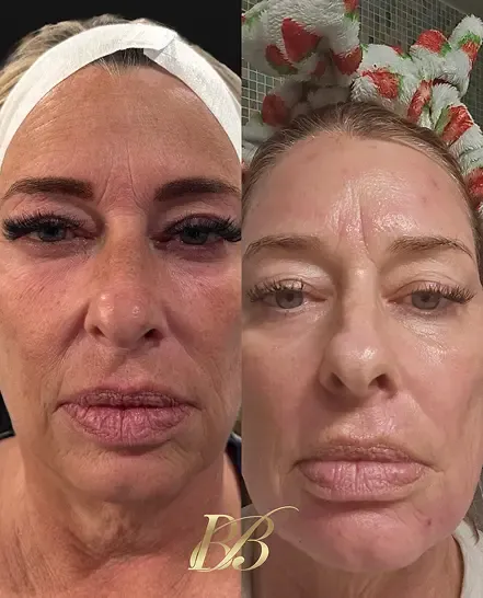 Before and after