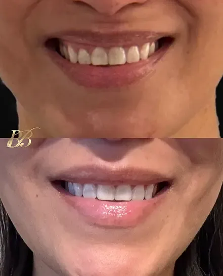 Before and after