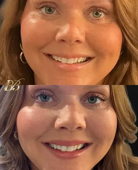 Before and after
