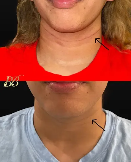Before and after