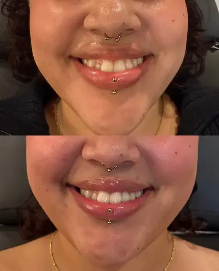 Before and after
